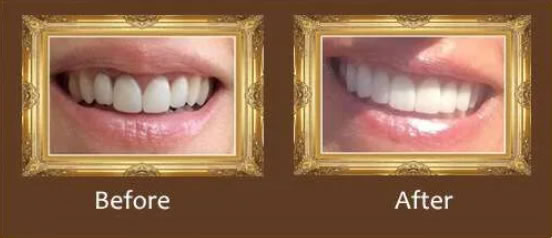 implants_greenacres dentures_greenacres